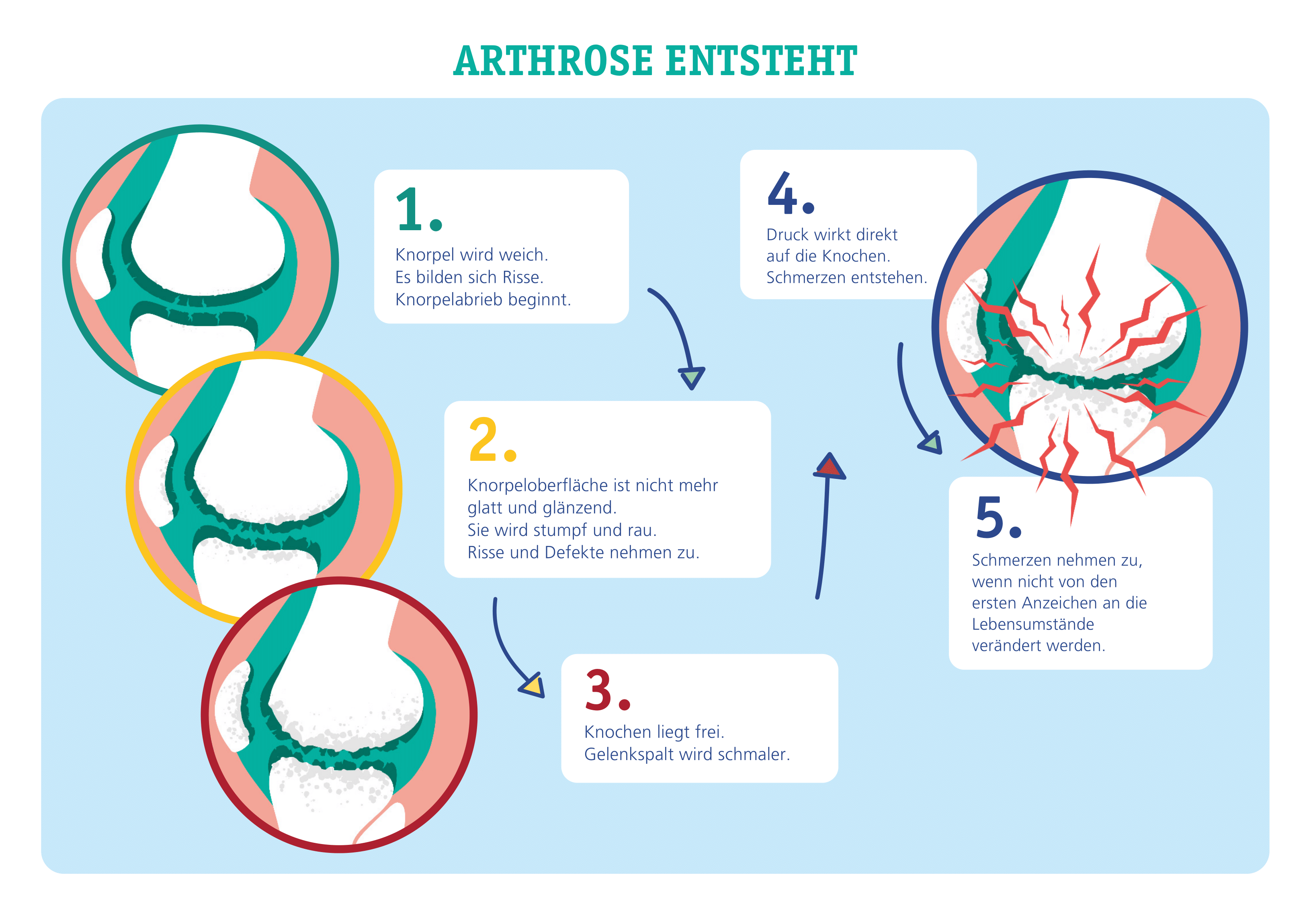 Arthrose: Behandlung und Symptome von Gelenkverschleiß
